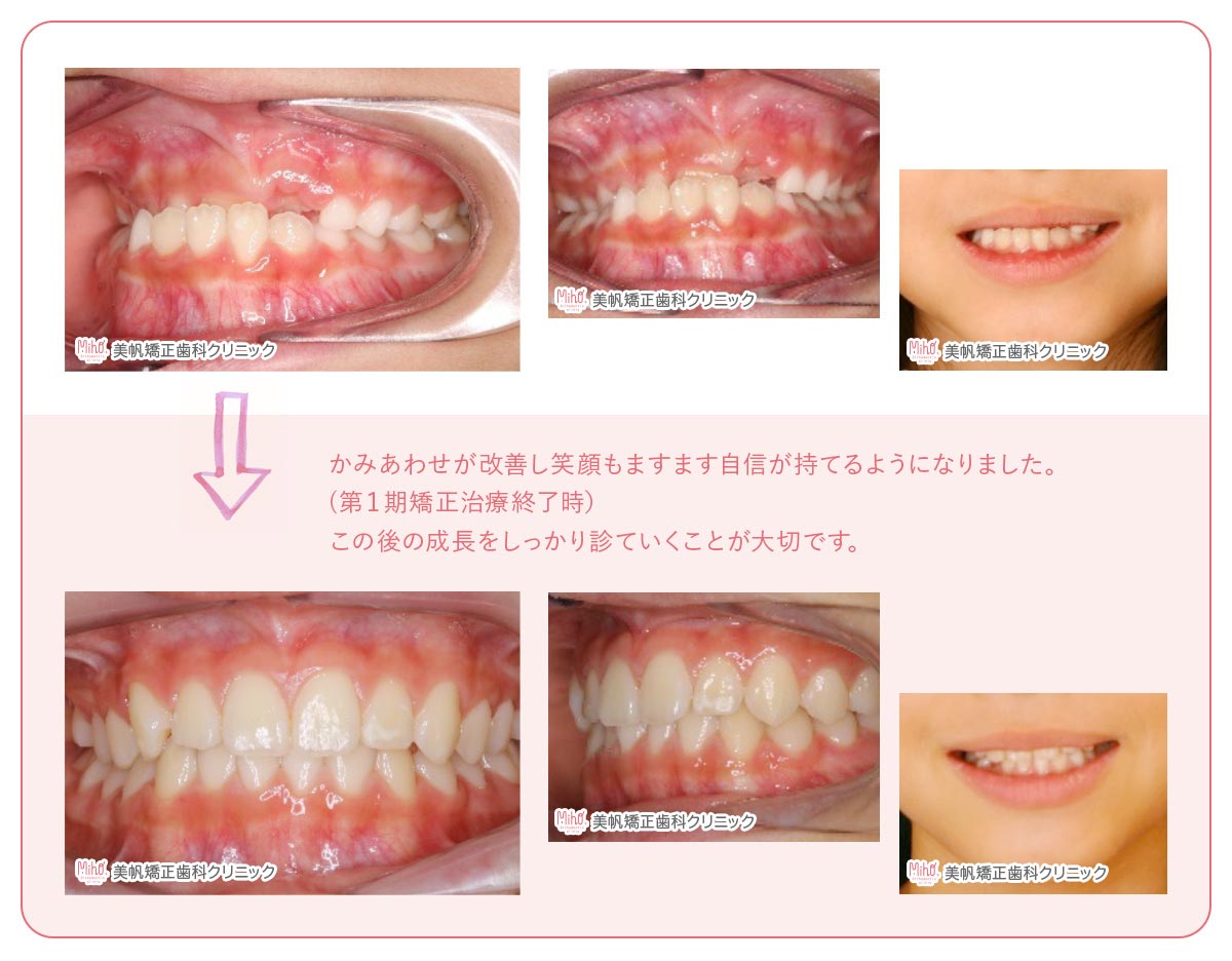 こどもの矯正治療 | 美帆矯正歯科クリニック