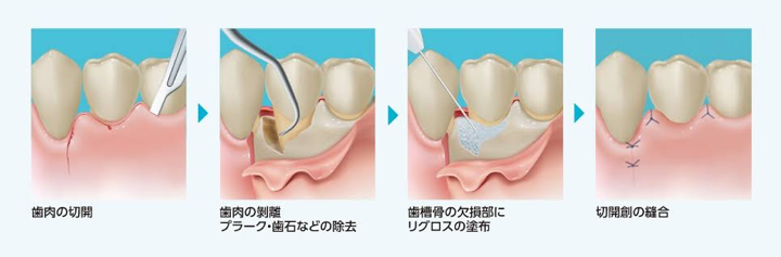 再生療法 | MKデンタルオフィス（山口市、山口駅、歯科医院）口コミの