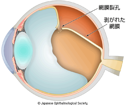東京都町田市で網膜剥離の治療・手術なら中原眼科｜町田駅より徒歩2分
