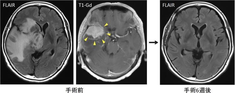 認知症の原因となる脳腫瘍 ｜ 国立長寿医療研究センター