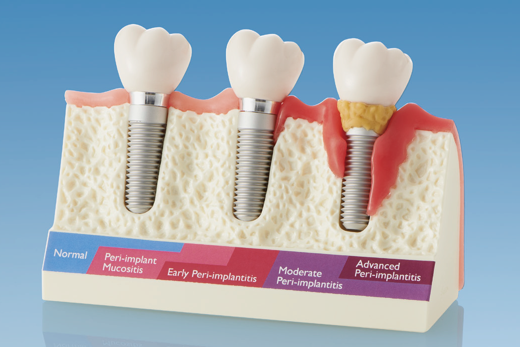 インプラント周囲病変模型 [PE-IMP004]｜株式会社ニッシン｜歯科模型