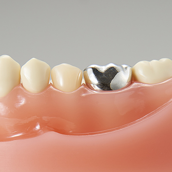 補綴物説明用模型 [PE-PRO019]｜株式会社ニッシン｜歯科模型・歯科材料