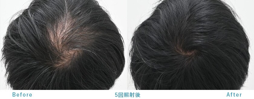 発毛レーザー Folix｜【公式】湘南AGAクリニック-AGA治療・薄毛治療の