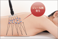 RAFOS mini コンパクトラジオ波（セルフ可能高周波）｜誠鋼社