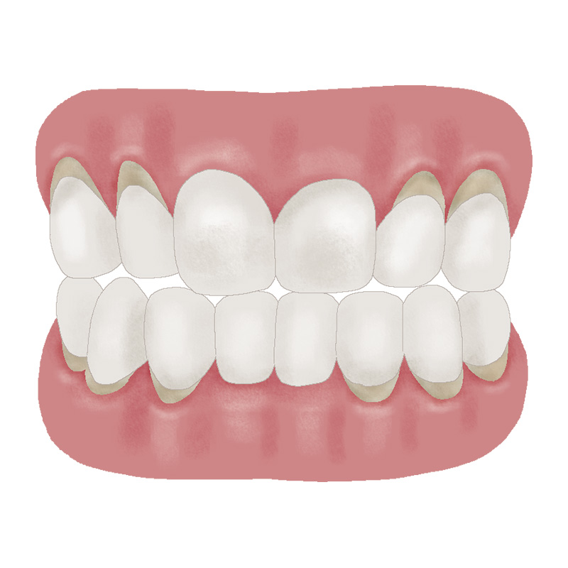 非う蝕性歯頸部歯質欠損（NCCL） | 歯科用語