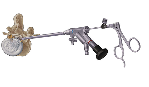 全脊椎内視鏡手術(FESS） | 整形外科 | 医療法人社団 誠馨会 新東京病院