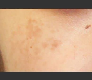 茶色の色素性病変治療にQスイッチルビーレーザー | 美容整形なら品川