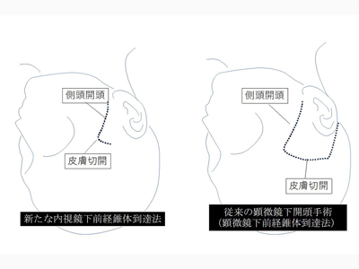 頭蓋底脳腫瘍、内視鏡を用いた新たな低侵襲開頭手術法を確立－大阪公立