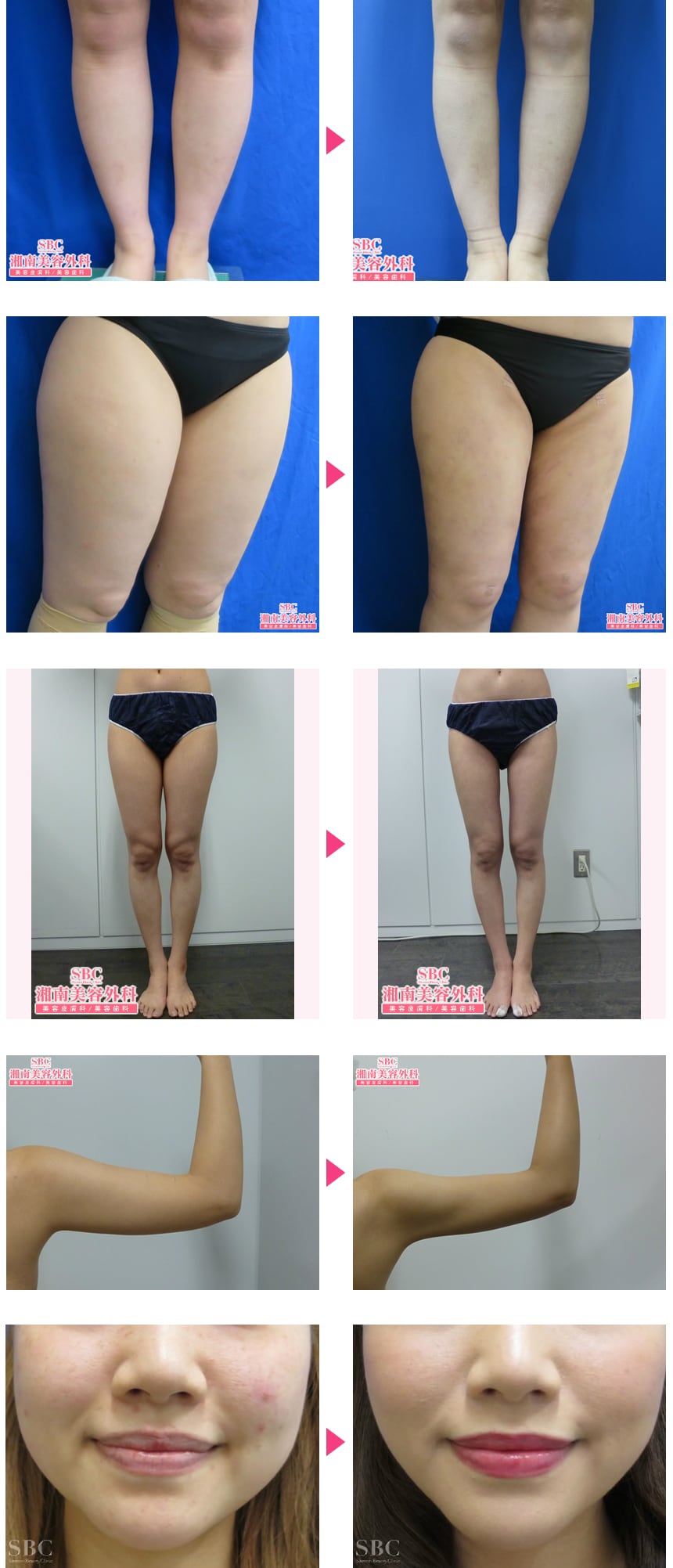 お手頃価格】【顔・二の腕脂肪吸引】症例…｜脂肪吸引モニター募集