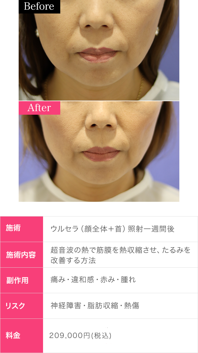 ウルセラのHIFU(ハイフ)による効果・持続期間｜リフトアップ(たるみ