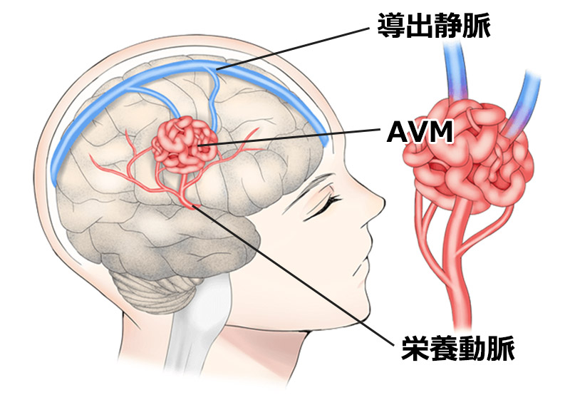 脳動静脈奇形（AVM）治療センター | 社会医療法人寿会 富永病院 （大阪）