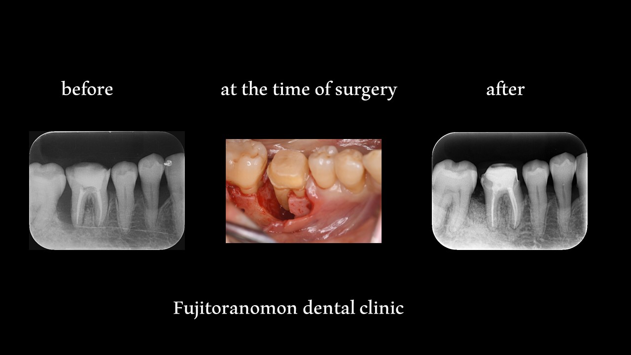 抜歯以外の選択肢 歯周組織再生療法を行った症例|坂戸駅南口正面の
