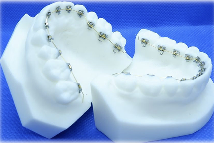 舌側矯正 ｜虎ノ門の歯医者 東京虎ノ門グローバルスクエア歯科