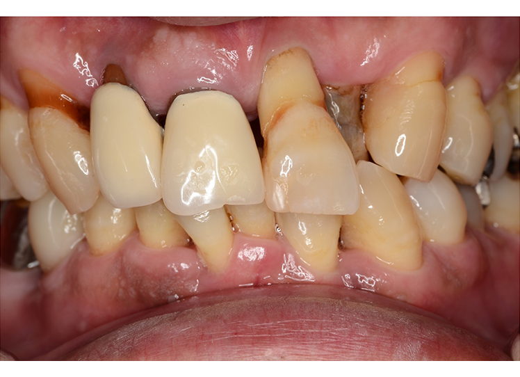 40代・50代】「歯がボロボロ」を治したい方へ - 東京で上手な歯医者