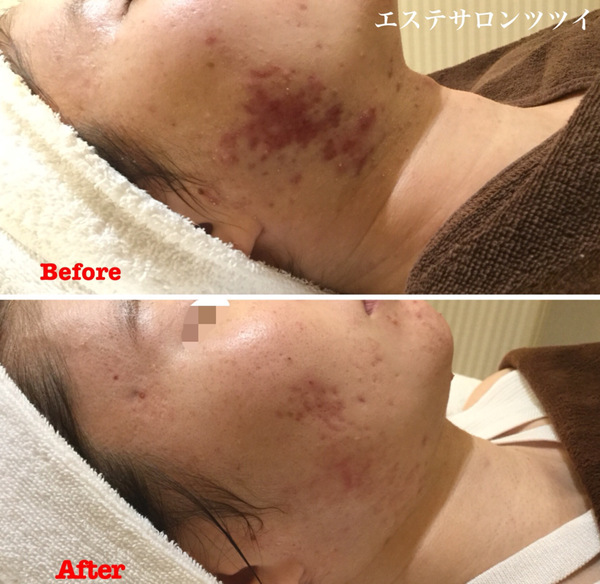 ニキビに効果絶大！エンビロンLACマスクは毎日使ってもいいの？効果