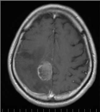 脳腫瘍 | 東京女子医科大学附属足立医療センター 脳神経外科
