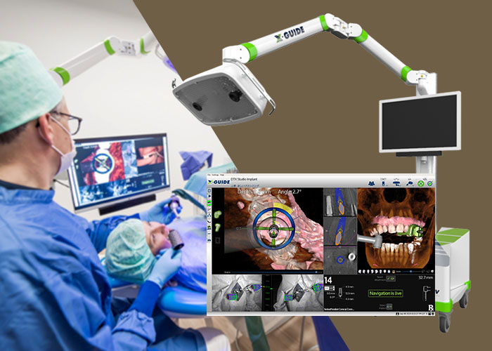 神戸でインプラントなら神戸市灘区うしじま歯科クリニックへ｜X-ガイド