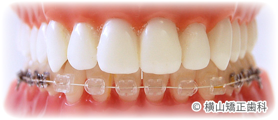 リンガルブラケット | 横山矯正歯科 公式サイト横山矯正歯科 公式サイト