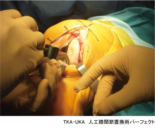 TKA・UKA 人工膝関節置換術パーフェクト〜人工膝関節全置換術・人工膝