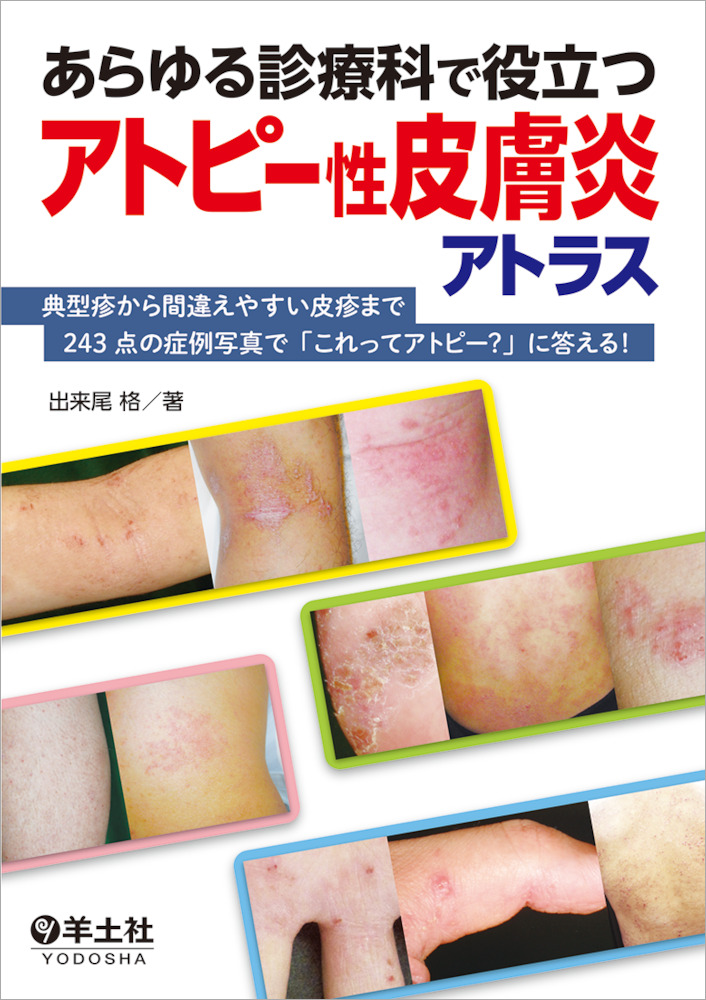 あらゆる診療科で役立つアトピー性皮膚炎アトラス〜典型疹から間違え