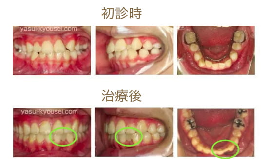 子どもの矯正 | 宮崎台やすい矯正歯科クリニック｜宮崎台駅前の矯正