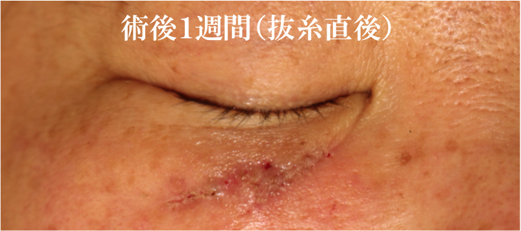 Scar Revision （瘢痕形成術） – 医療法人 双英会 YUKI皮フ科形成外科