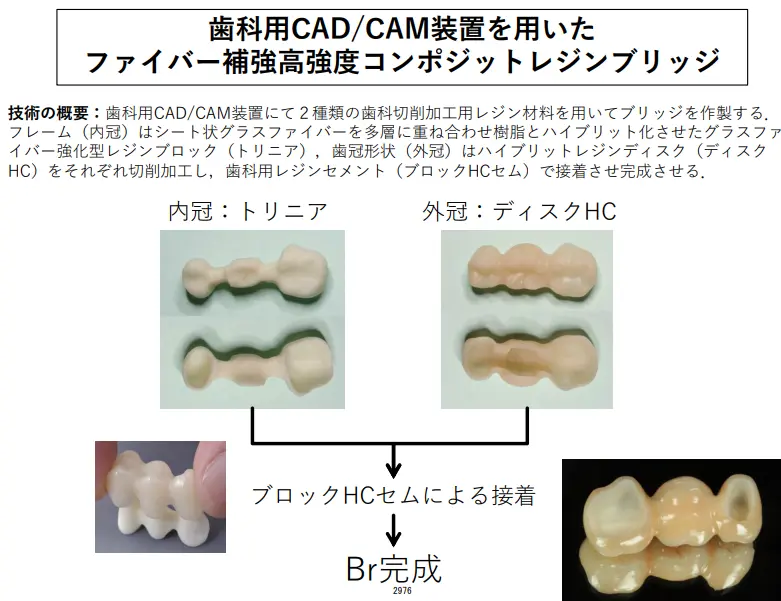 PEEK冠とは？保険適用になった新規材料について特徴を解説 | 八島歯科