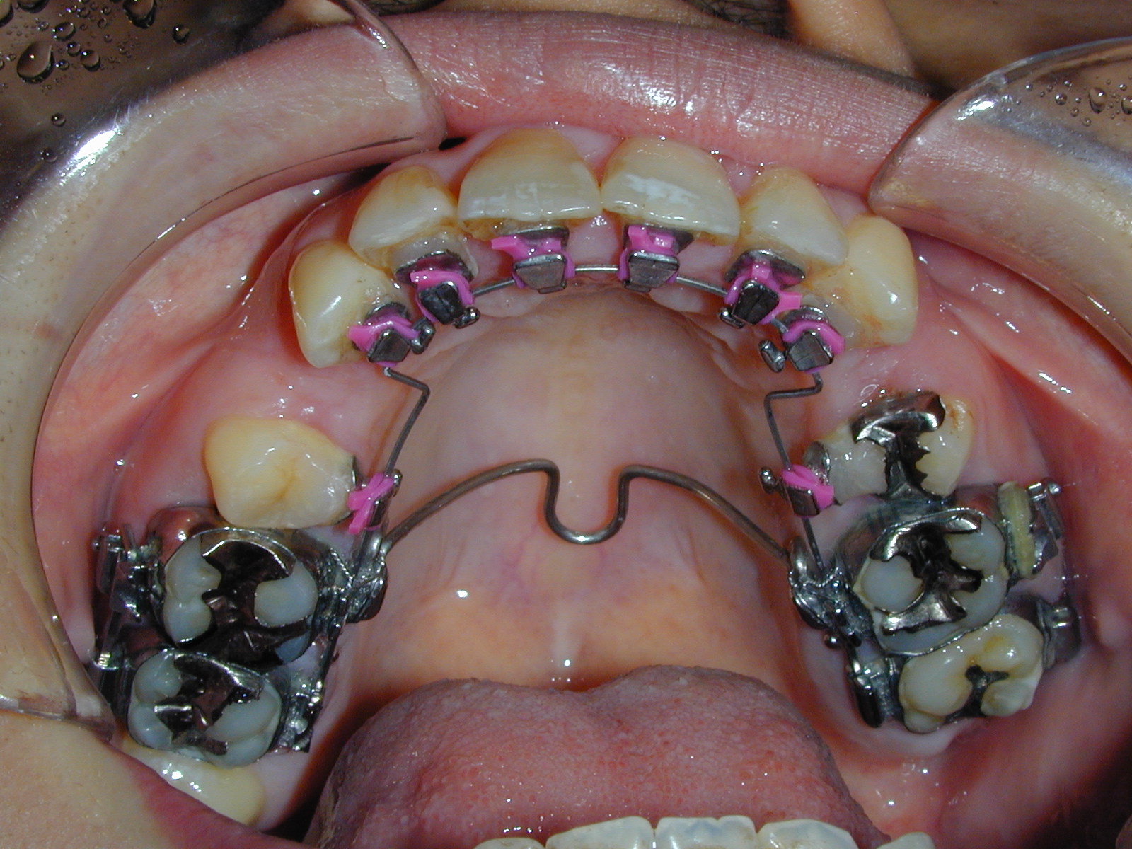 舌側矯正 | 横浜 矯正歯科｜村田歯科・横浜矯正歯科センター 横浜駅前