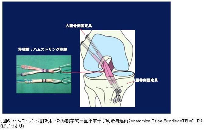 膝の靱帯手術を受けられる患者様へ | 診療科・部門 | 社会医療法人 行