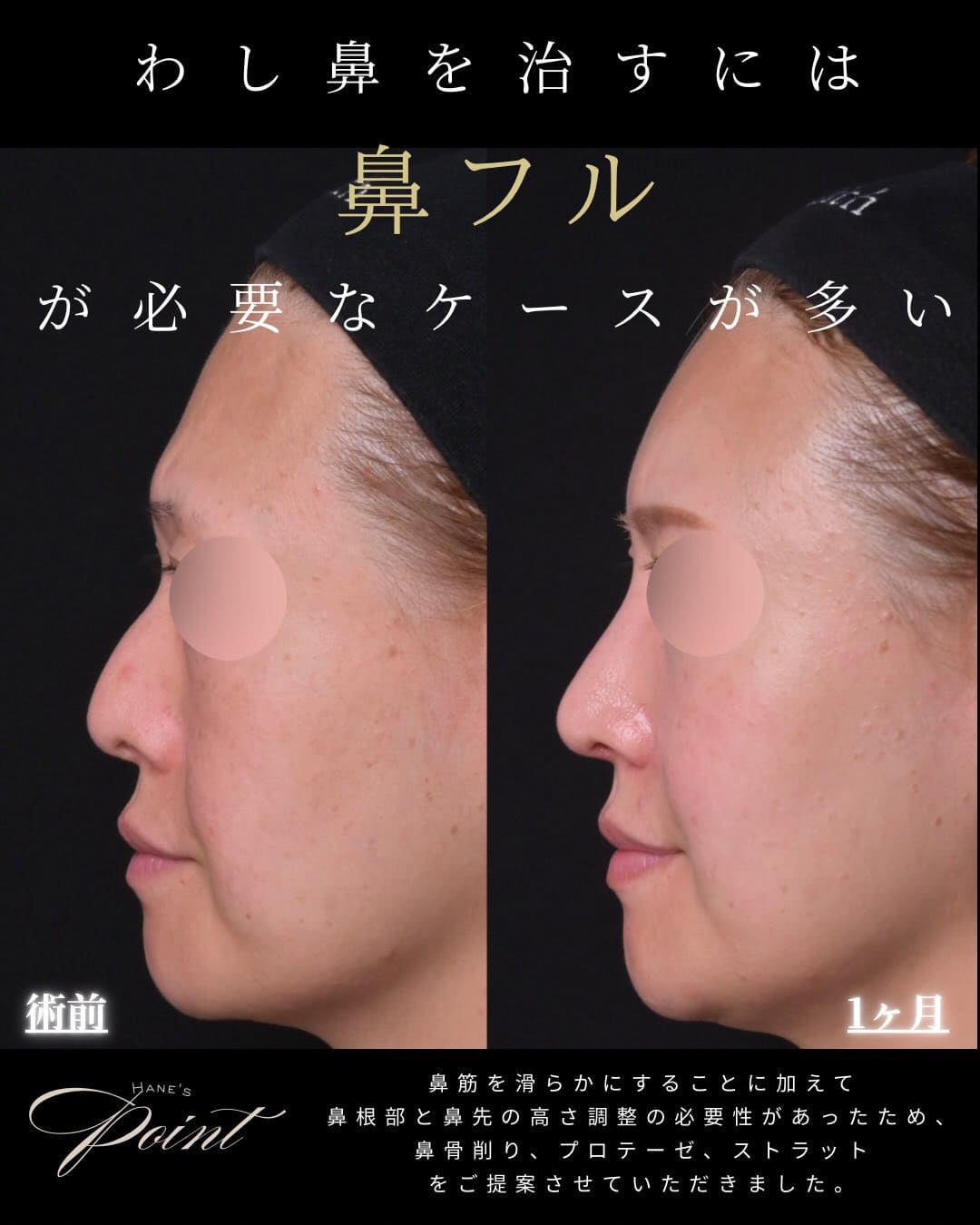 鼻整形 - ゼティスビューティークリニック｜鼻整形・鼻形成、美肌専門