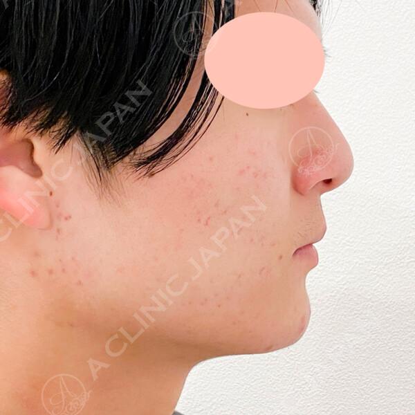 ニキビ肌や凸凹のお肌を美肌に改善♪ダーマペン4の処置前と3回目処置後