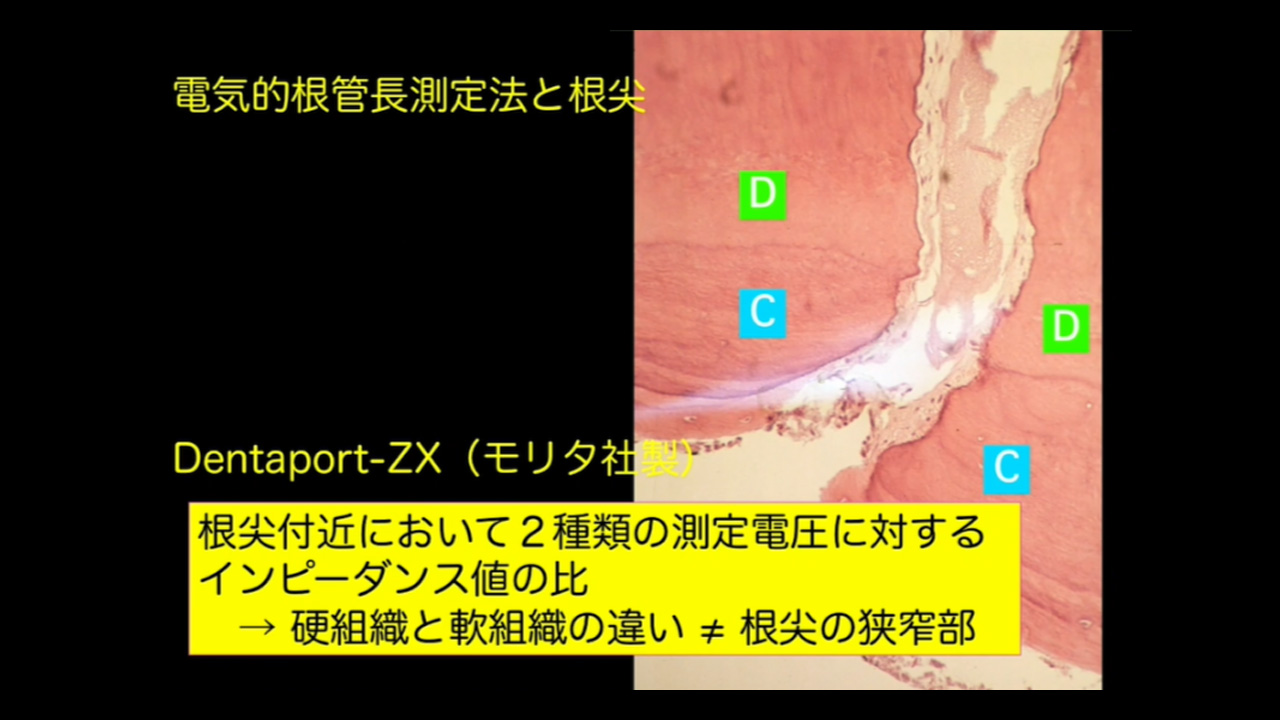 人気動画】抜髄・Initial treatmentの勘所：木ノ本喜史先生
