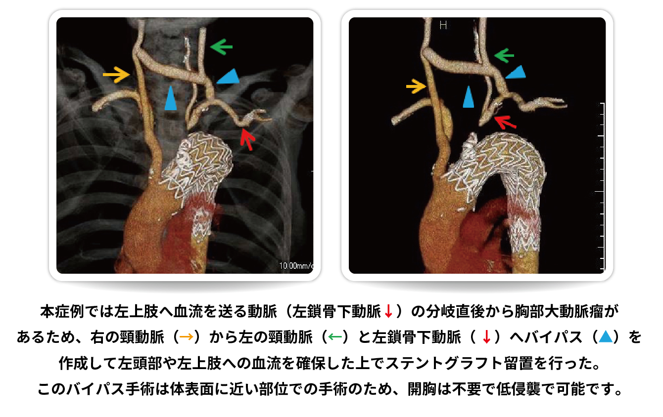 ステントグラフト留置術 | 兵庫県立尼崎総合医療センター（AGMC