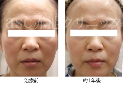 マツコデラックスが、ゴールドロールキットとNEWAリフトを「買います