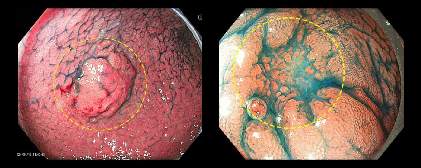 胃がん｜消化器｜診療内容｜医療法人 甘木第一クリニック