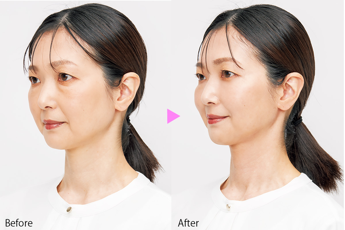 絶対に失敗しない美顔器】1回の使用で小顔になれる!?実際に試してみた