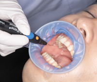 FEEDデンタル】オプトラゲートの通販｜開口器、ティッシュリトラクター