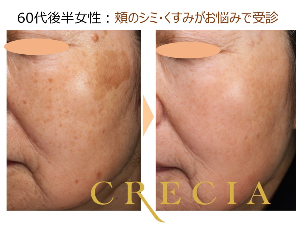 美肌カスタマイズ治療とは？ | 葛飾区の美容皮膚科：クレシア