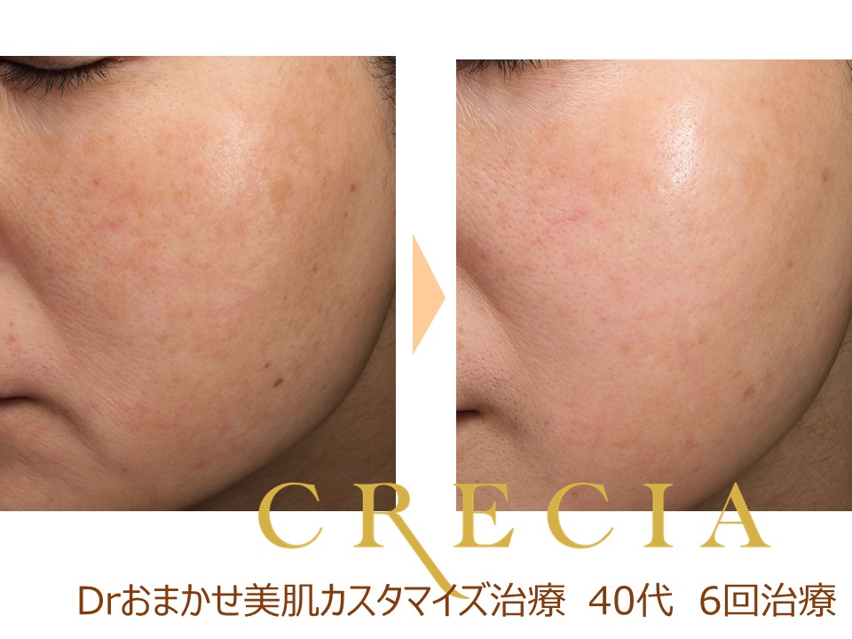 イオン導入 | 葛飾区の美容皮膚科：クレシアスキンケアクリニック