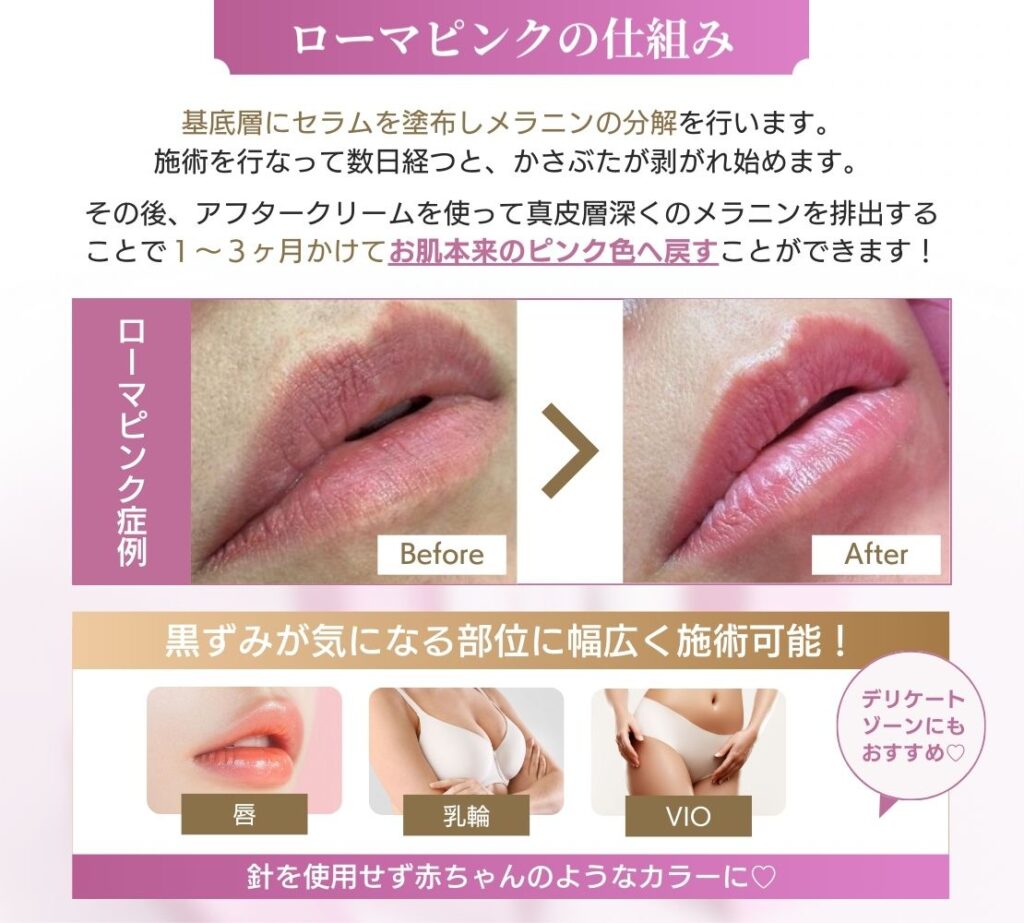 新宿】ローマピンク導入 | 新宿・大阪心斎橋・名古屋・福岡の美容