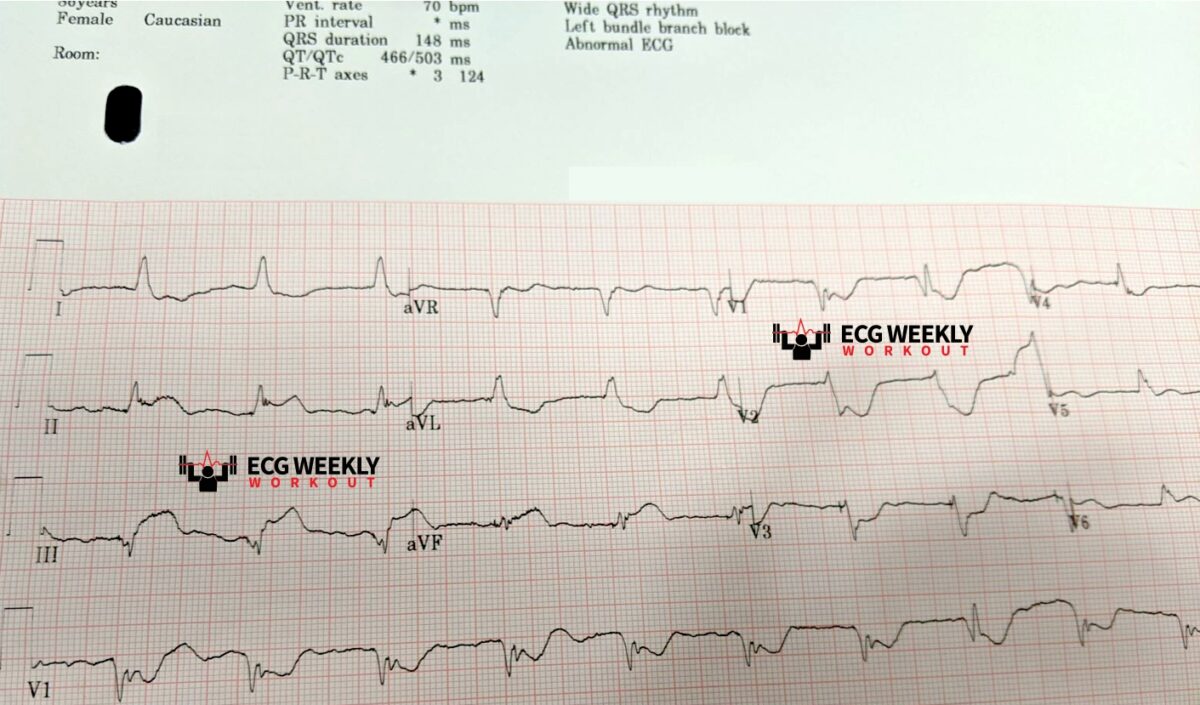 STAT ECG Diagnoses: diagnosis of acute myocardial infarction (MI