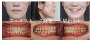 受け口（反対咬合）の矯正歯科治療 | 医療法人社団 FACE AND SMILE