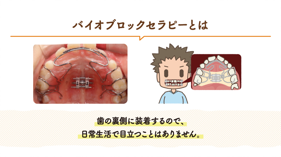 矯正について(バイオブロックセラピー) | 藤井歯科矯正歯科