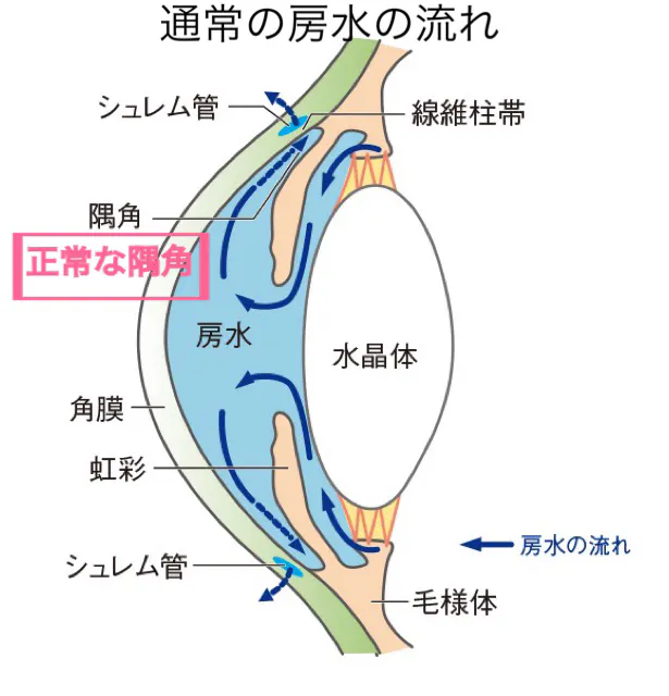 見逃さないで！ “狭隅角”が引き起こす急性緑内障発作 - 福村眼科