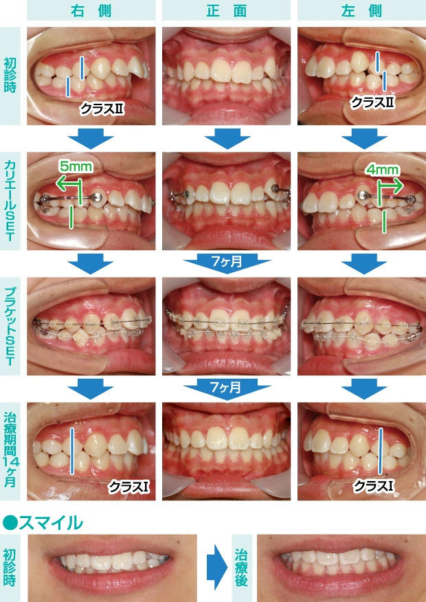 Vol.146 カリエールを用いた非抜歯矯正治療 No.4 | ふかつ歯科・矯正