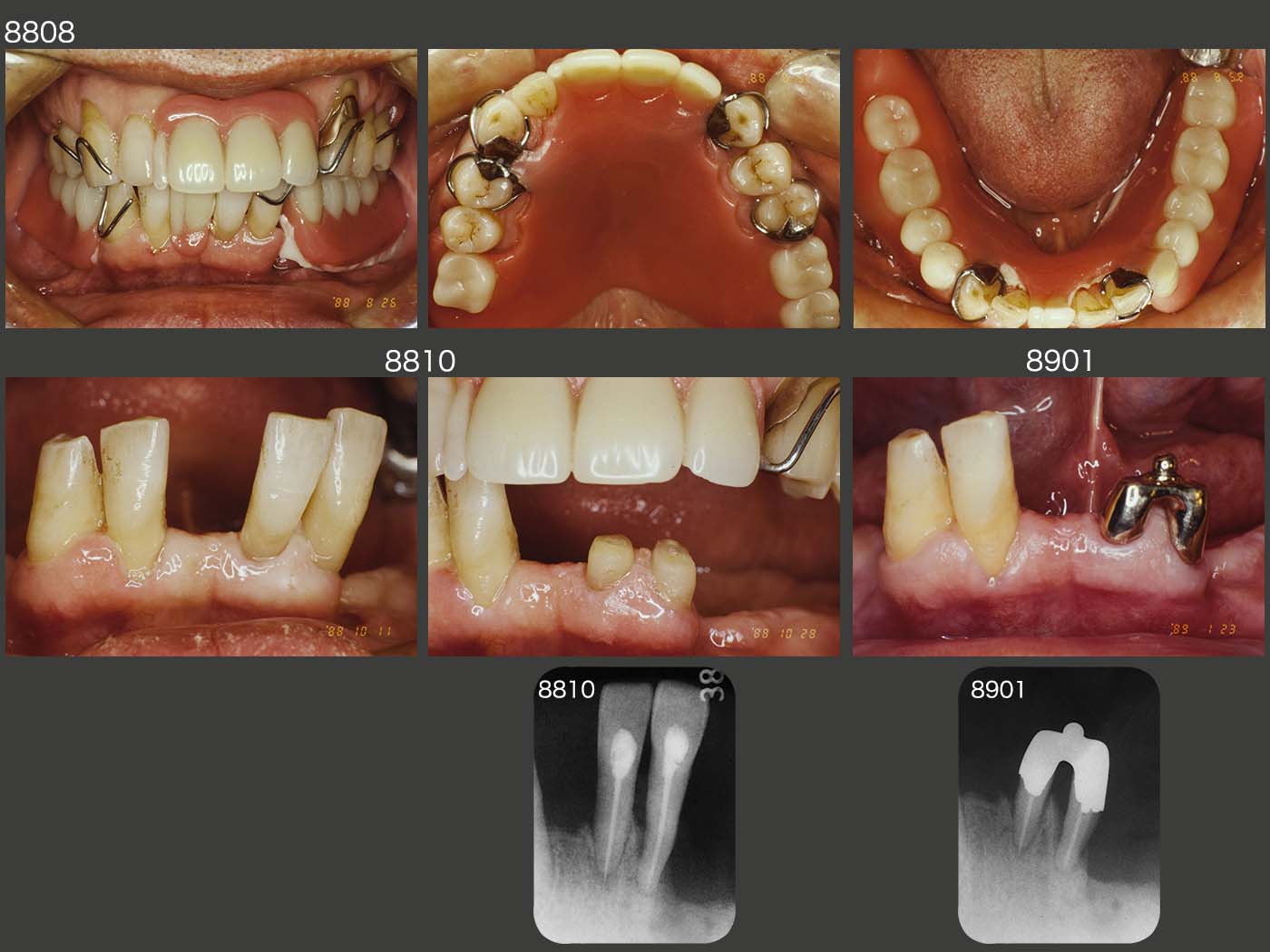 21.パーシャルデンチャー31年7ヵ月経過症例 | 古屋歯科クリニック症例集
