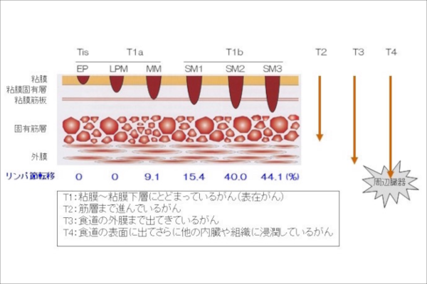 食道がんの進行度 – 京都大学消化管外科
