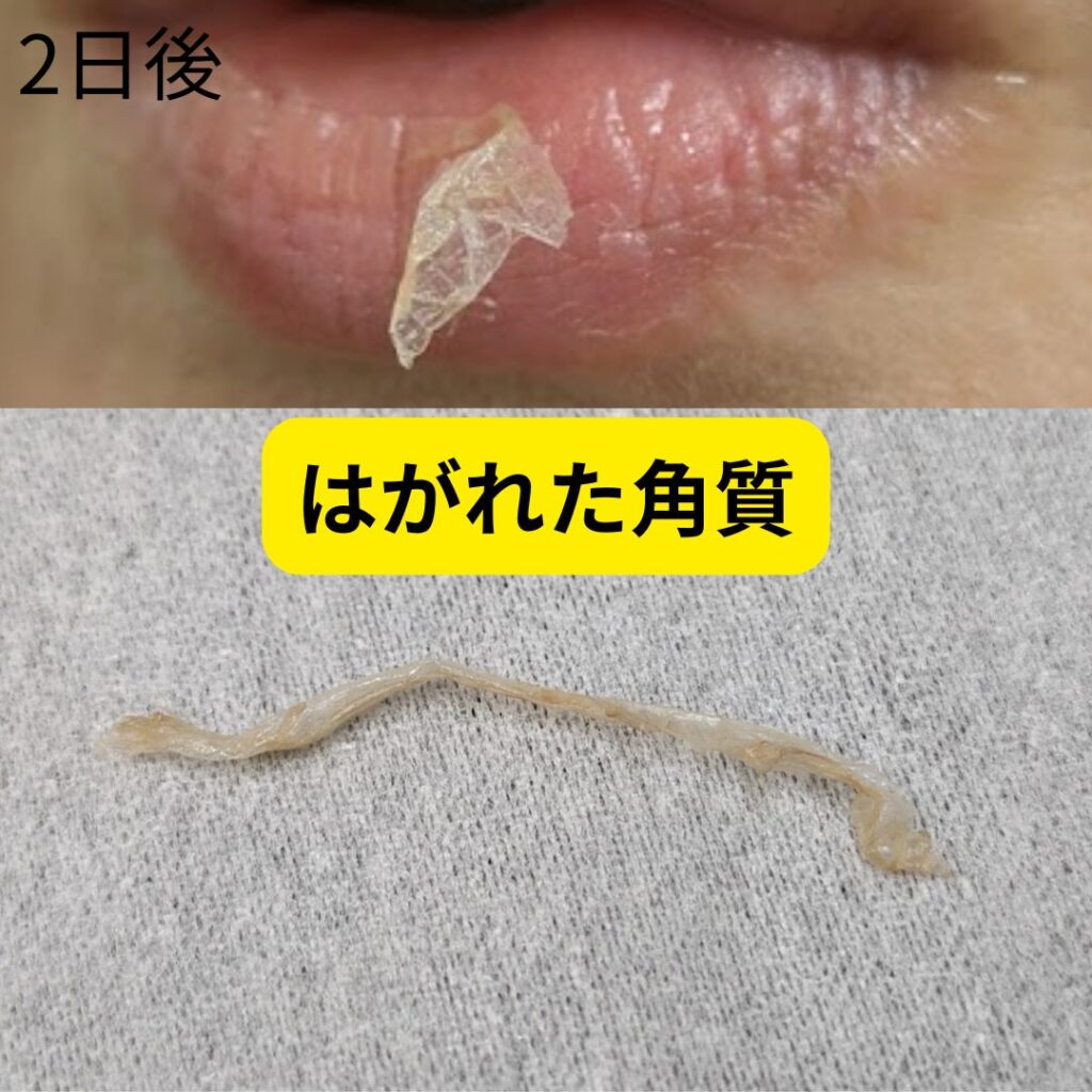 医師解説】ローマピンクはアフタークリームだけでも効果あるかも