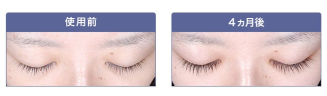 睫毛貧毛症治療薬（まつ毛育毛治療薬）Glash vista/グラッシュビスタ