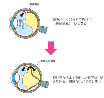 網膜剥離｜水戸市の日帰り手術専門の眼科｜はねもと眼科